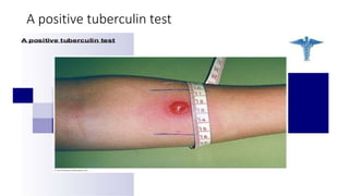 A positive tuberculin test
 