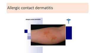 Allergic contact dermatitis
 
