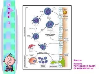 TYPE I Source: Robbins PATHOLOGIC BASIS OF DISEASE 6 th  ed 