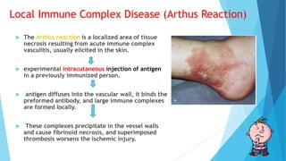 Local Immune Complex Disease (Arthus Reaction)
 The Arthus reaction is a localized area of tissue
necrosis resulting from acute immune complex
vasculitis, usually elicited in the skin.
 experimental intracutaneous injection of antigen
in a previously immunized person.
 antigen diffuses into the vascular wall, it binds the
preformed antibody, and large immune complexes
are formed locally.
 These complexes precipitate in the vessel walls
and cause fibrinoid necrosis, and superimposed
thrombosis worsens the ischemic injury.
 