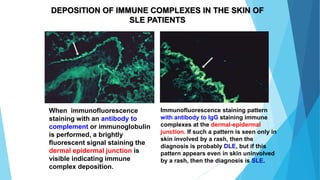 When immunofluorescence
staining with an antibody to
complement or immunoglobulin
is performed, a brightly
fluorescent signal staining the
dermal epidermal junction is
visible indicating immune
complex deposition.
Immunofluorescence staining pattern
with antibody to IgG staining immune
complexes at the dermal-epidermal
junction. If such a pattern is seen only in
skin involved by a rash, then the
diagnosis is probably DLE, but if this
pattern appears even in skin uninvolved
by a rash, then the diagnosis is SLE.
DEPOSITION OF IMMUNE COMPLEXES IN THE SKIN OF
SLE PATIENTS
 