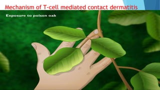 Mechanism of T-cell mediated contact dermatitis
 