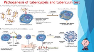 Pathogenesis of tuberculosis and tuberculin test
Mtb activate TLR2 which
makes apc produce IL12
 