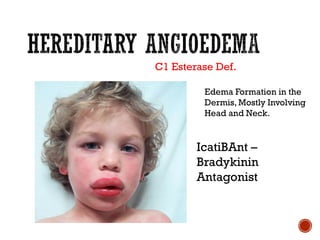 Edema Formation in the
Dermis, Mostly Involving
Head and Neck.
IcatiBAnt –
Bradykinin
Antagonist
C1 Esterase Def.
 