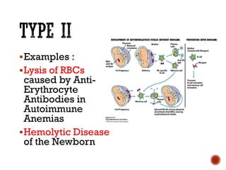 ▪Examples :
▪Lysis of RBCs
caused by Anti-
Erythrocyte
Antibodies in
Autoimmune
Anemias
▪Hemolytic Disease
of the Newborn
 