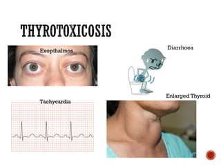 Exopthalmos
Diarrhoea
Tachycardia
Enlarged Thyroid
 