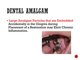 ▪ Large Amalgam Particles that are Embedded
Accidentally in the Gingiva during
Placement of a Restoration may Elicit Chronic
Inflammation.
 