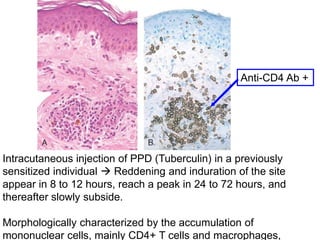 Ppd Injection Rash Hypersensitivity.ppt