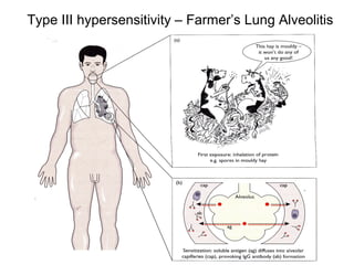 Type III hypersensitivity – Farmer’s Lung Alveolitis

 