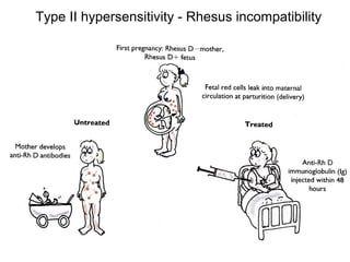Type II hypersensitivity - Rhesus incompatibility

 