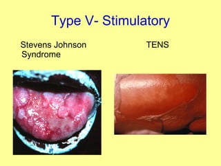 Type V- Stimulatory Stevens Johnson Syndrome   TENS 
