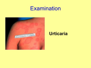 Examination Urticaria 