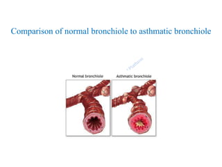 Comparison of normal bronchiole to asthmatic bronchiole
 