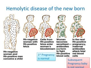 Hemolytic disease of the new born
1st Pregnancy
is normal Subsequent
Pregnancy baby
 