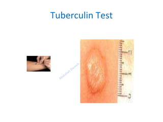 Tuberculin Test
 