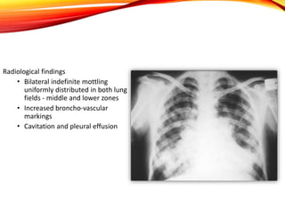Radiological findings
• Bilateral indefinite mottling
uniformly distributed in both lung
fields - middle and lower zones
• Increased broncho-vascular
markings
• Cavitation and pleural effusion
 