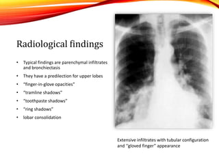 Radiological findings
• Typical findings are parenchymal infiltrates
and bronchiectasis
• They have a predilection for upper lobes
• “finger-in-glove opacities”
• “tramline shadows”
• “toothpaste shadows”
• “ring shadows”
• lobar consolidation
Extensive infiltrates with tubular configuration
and ‘‘gloved finger” appearance
 