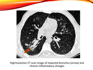 Highresolution CT scan image of impacted bronchus (arrow) and
chronic inflammatory changes
 