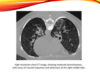 High-resolution chest CT image, showing moderate bronchiectasis,
with areas of mucoid impaction and atelectasis of the right middle lobe.
 