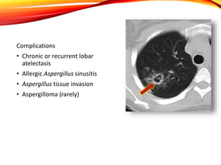 Complications
• Chronic or recurrent lobar
atelectasis
• Allergic Aspergillus sinusitis
• Aspergillus tissue invasion
• Aspergilloma (rarely)
 