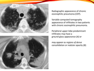 Radiographic appearance of chronic
eosinophilic pneumonia (CEP).
Variable computed tomography
appearance of infiltrates in two patients
with chronic eosinophilic pneumonia.
Peripheral upper-lobe predominant
infiltrates may have a
ground-glass appearance (A) or
may appear as regions of dense
consolidation or nodular opacity (B).
 