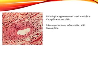 Pathological appearance of small arteriole in
Churg-Strauss vasculitis.
Intense perivascular inflammation with
Eosinophilia.
 