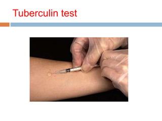 Tuberculin test
 