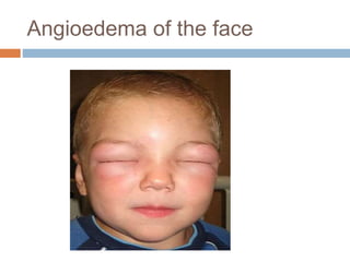 Angioedema of the face
 