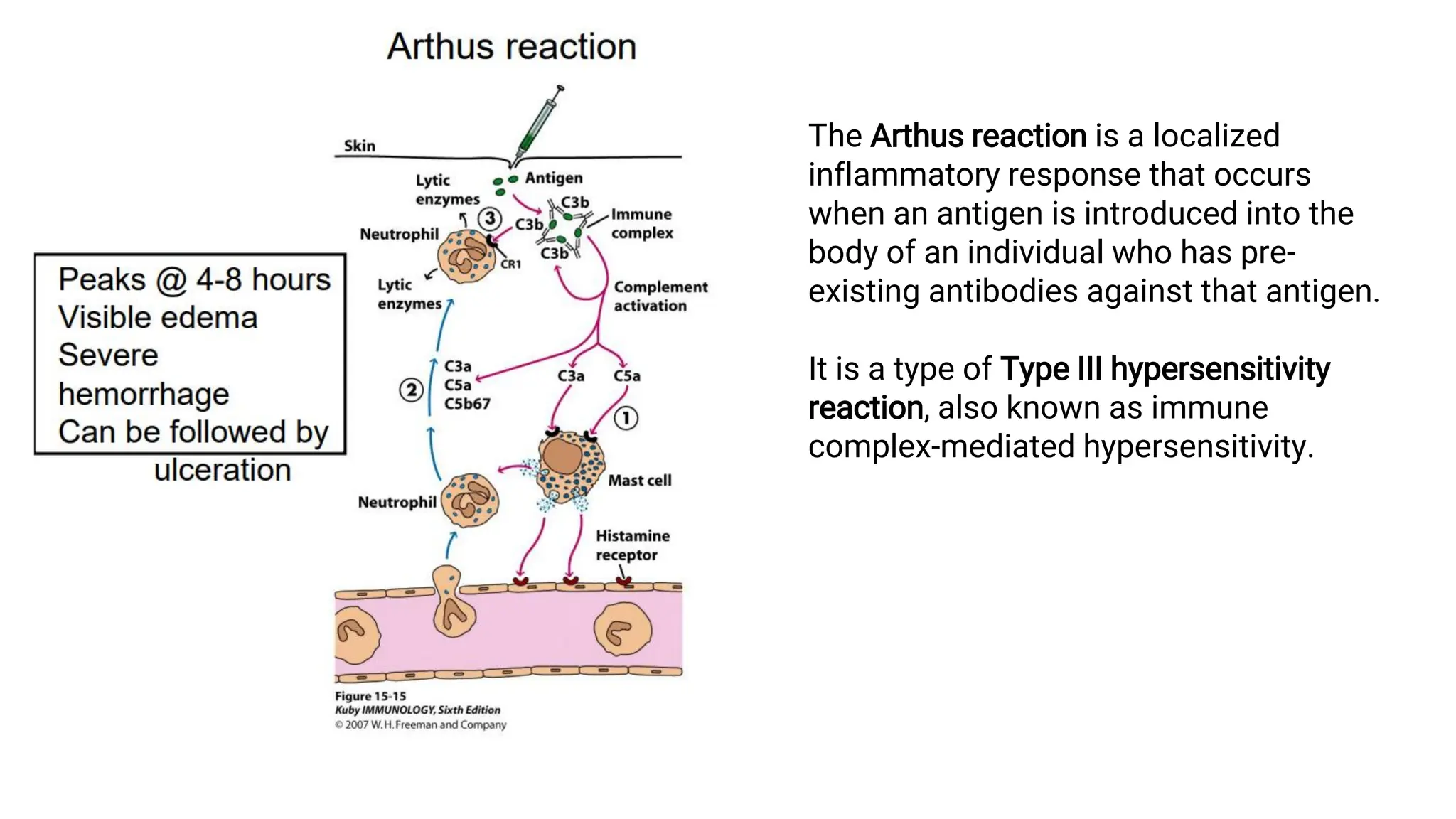 The Arthus reaction is a localized
inflammatory response that occurs
when an antigen is introduced into the
body of an individual who has pre-
existing antibodies against that antigen.
It is a type of Type III hypersensitivity
reaction, also known as immune
complex-mediated hypersensitivity.
 
