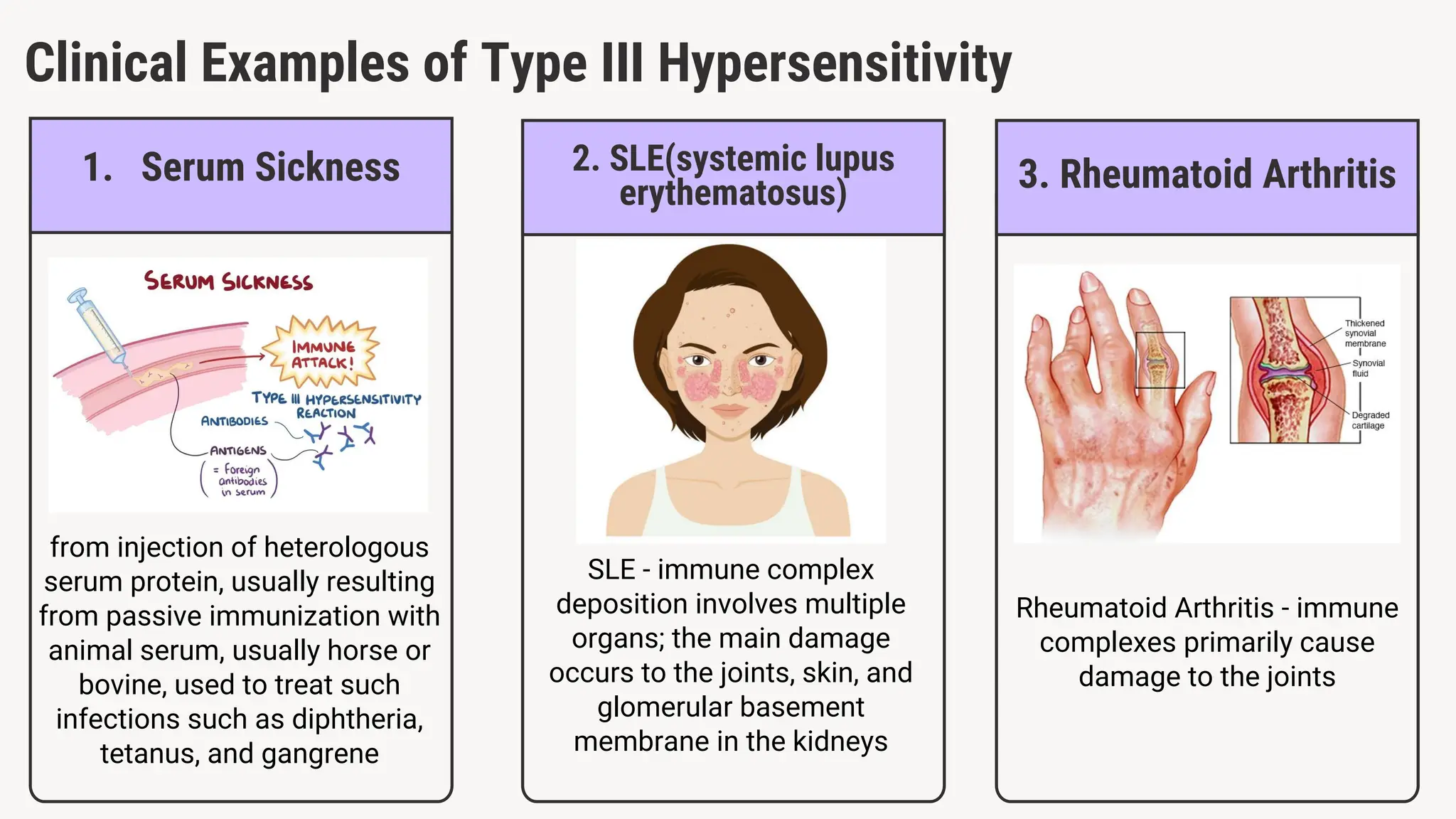 Clinical Examples of Type III Hypersensitivity
1. Serum Sickness
from injection of heterologous
serum protein, usually resulting
from passive immunization with
animal serum, usually horse or
bovine, used to treat such
infections such as diphtheria,
tetanus, and gangrene
2. SLE(systemic lupus
erythematosus)
SLE - immune complex
deposition involves multiple
organs; the main damage
occurs to the joints, skin, and
glomerular basement
membrane in the kidneys
3. Rheumatoid Arthritis
Rheumatoid Arthritis - immune
complexes primarily cause
damage to the joints
 