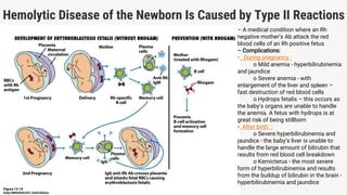 Hemolytic Disease of the Newborn Is Caused by Type II Reactions
– A medical condition where an Rh
negative mother’s Ab attack the red
blood cells of an Rh positive fetus
– Complications:
• During pregnancy :
o Mild anemia - hyperbilirubinemia
and jaundice
o Severe anemia - with
enlargement of the liver and spleen –
fast destruction of red blood cells
o Hydrops fetalis – this occurs as
the baby’s organs are unable to handle
the anemia. A fetus with hydrops is at
great risk of being stillborn
• After birth :
o Severe hyperbilirubinemia and
jaundice - the baby’s liver is unable to
handle the large amount of bilirubin that
results from red blood cell breakdown
o Kernicterus - the most severe
form of hyperbilirubinemia and results
from the buildup of bilirubin in the brain -
hyperbilirubinemia and jaundice
 