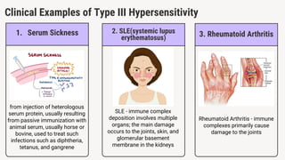 Clinical Examples of Type III Hypersensitivity
1. Serum Sickness
from injection of heterologous
serum protein, usually resulting
from passive immunization with
animal serum, usually horse or
bovine, used to treat such
infections such as diphtheria,
tetanus, and gangrene
2. SLE(systemic lupus
erythematosus)
SLE - immune complex
deposition involves multiple
organs; the main damage
occurs to the joints, skin, and
glomerular basement
membrane in the kidneys
3. Rheumatoid Arthritis
Rheumatoid Arthritis - immune
complexes primarily cause
damage to the joints
 