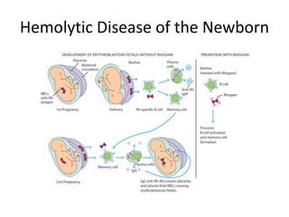 Hemolytic Disease of the Newborn
 