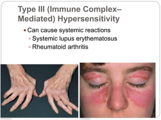 Type III (Immune Complex–
Mediated) Hypersensitivity
 Can cause systemic reactions
 Systemic lupus erythematosus
 Rheumatoid arthritis
 