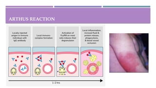 Comprehensive Overview of Hypersensitivity Reactions and Immune System ...