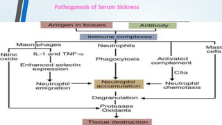 Pathogenesis of Serum Sickness
 