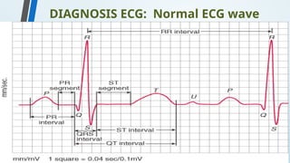 DIAGNOSIS ECG: Normal ECG wave
 