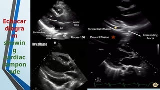 Echocar
diogra
m
showin
g
cardiac
tampon
ade
 