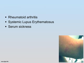  Rheumatoid arthritis
 Systemic Lupus Erythematosus
 Serum sickness
 