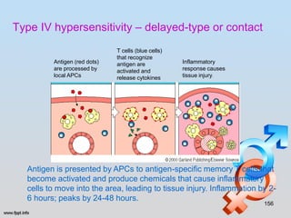 Type IV hypersensitivity – delayed-type or contact
                              T cells (blue cells)
                              that recognize
         Antigen (red dots)   antigen are            Inflammatory
         are processed by     activated and          response causes
         local APCs           release cytokines      tissue injury.




  Antigen is presented by APCs to antigen-specific memory T cells that
  become activated and produce chemicals that cause inflammatory
  cells to move into the area, leading to tissue injury. Inflammation by 2-
  6 hours; peaks by 24-48 hours.
                                                                       156
 