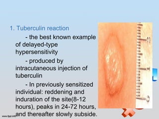 1. Tuberculin reaction
      - the best known example
  of delayed-type
  hypersensitivity
      - produced by
  intracutaneous injection of
  tuberculin
      - In previously sensitized
  individual: reddening and
  induration of the site(8-12
  hours), peaks in 24-72 hours,
  and thereafter slowly subside.
 