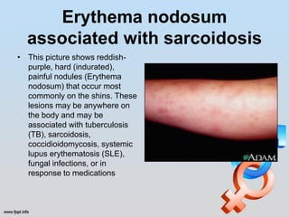 Erythema nodosum
  associated with sarcoidosis
• This picture shows reddish-
  purple, hard (indurated),
  painful nodules (Erythema
  nodosum) that occur most
  commonly on the shins. These
  lesions may be anywhere on
  the body and may be
  associated with tuberculosis
  (TB), sarcoidosis,
  coccidioidomycosis, systemic
  lupus erythematosis (SLE),
  fungal infections, or in
  response to medications
 