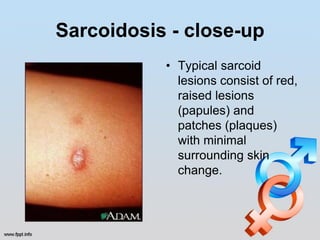Sarcoidosis - close-up
           • Typical sarcoid
             lesions consist of red,
             raised lesions
             (papules) and
             patches (plaques)
             with minimal
             surrounding skin
             change.
 