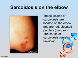 Sarcoidosis on the elbow
            • These lesions of
              sarcoidosis are
              located on the elbow
              and are red, elevated
              patches (plaques).
              The cause of
              sarcoidosis remains
              unknown.
 