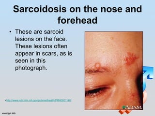 Sarcoidosis on the nose and
               forehead
   • These are sarcoid
     lesions on the face.
     These lesions often
     appear in scars, as is
     seen in this
     photograph.




•http://www.ncbi.nlm.nih.gov/pubmedhealth/PMH0001140/
 