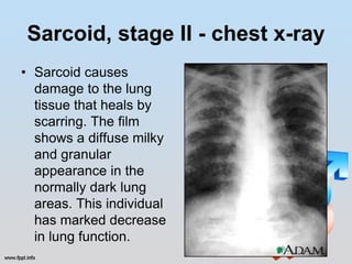 Sarcoid, stage II - chest x-ray
• Sarcoid causes
  damage to the lung
  tissue that heals by
  scarring. The film
  shows a diffuse milky
  and granular
  appearance in the
  normally dark lung
  areas. This individual
  has marked decrease
  in lung function.
 