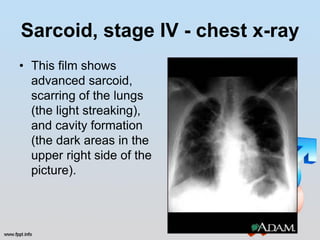 Sarcoid, stage IV - chest x-ray
• This film shows
  advanced sarcoid,
  scarring of the lungs
  (the light streaking),
  and cavity formation
  (the dark areas in the
  upper right side of the
  picture).
 