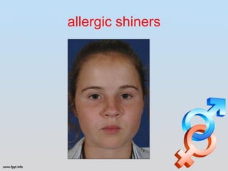 allergic shiners
 