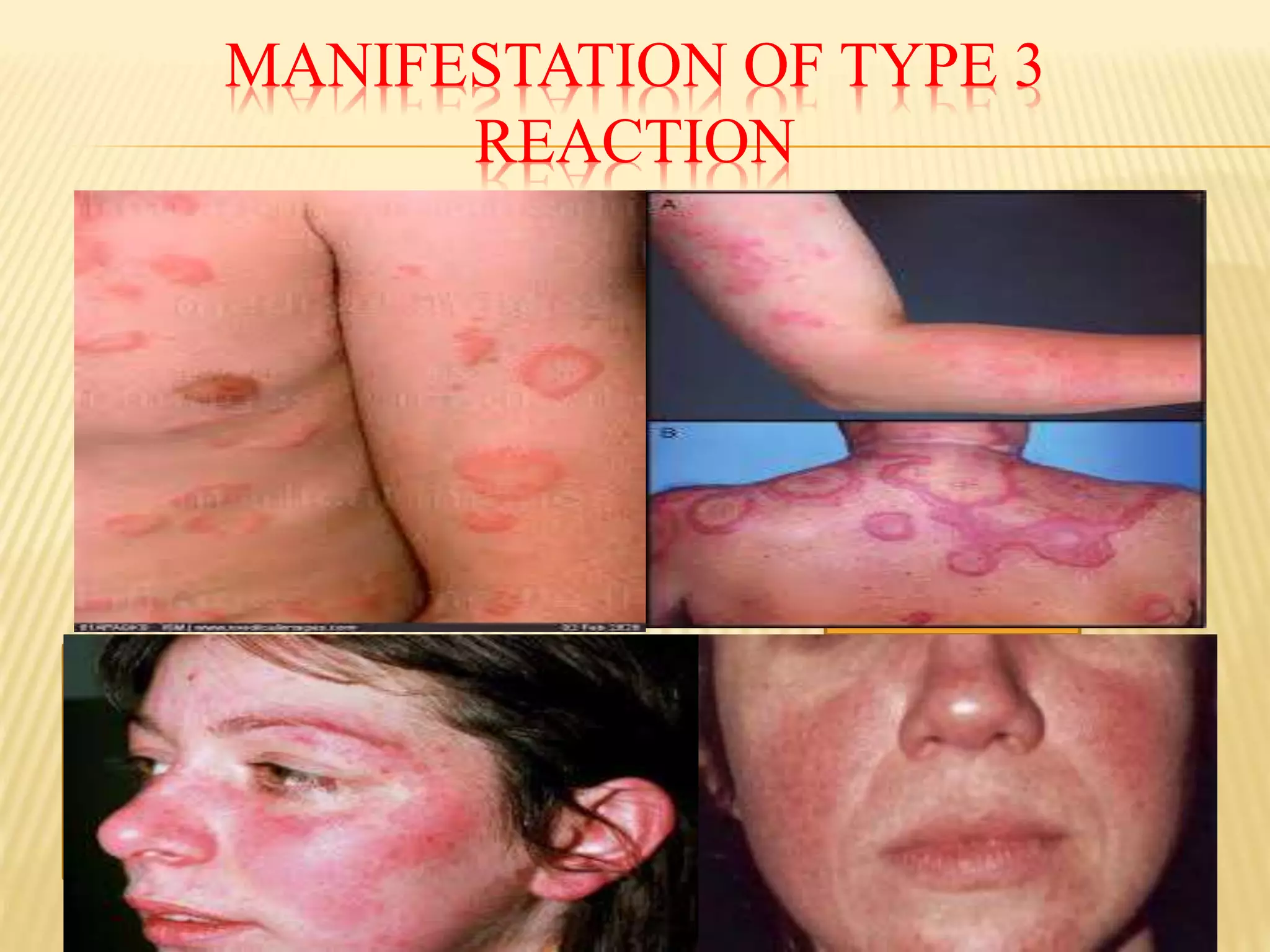 MANIFESTATION OF TYPE 3
REACTION
 