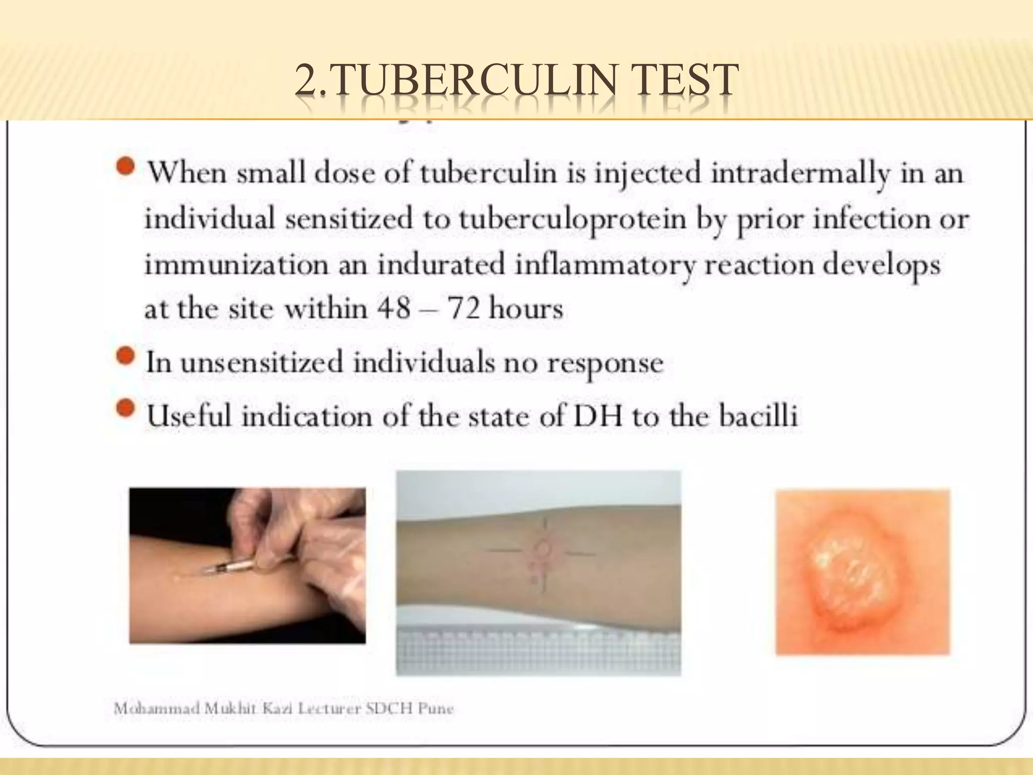 2.TUBERCULIN TEST
 